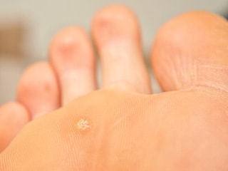 Chữa mụn cóc ở lòng bàn chân như thế nào?