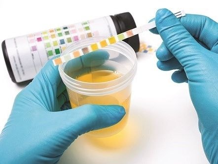 Đoán bệnh qua màu nước tiểu