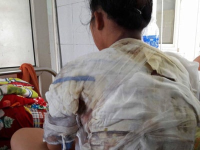 Bắt tạm giam người chồng dội nước sôi lên cổ vợ