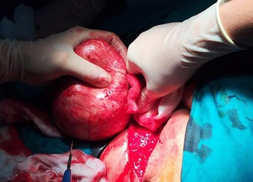 Cắt bỏ khối u ở mông nặng hơn 1 kg cho cụ bà gần 90 tuổi