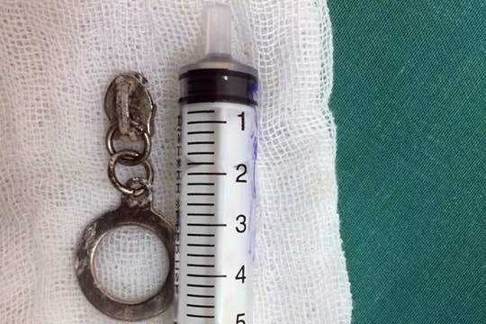 Hạt na nằm trong đường thở bé 3 tuổi