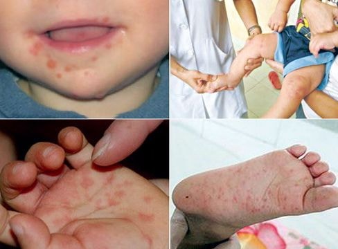 9 căn bệnh nguy cơ bùng phát mùa tựu trường