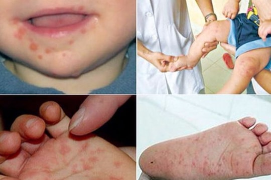 Cảnh báo 'nóng': Nguy cơ bùng phát dịch tay chân miệng