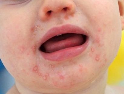 5 sai lầm khi chăm sóc trẻ mắc bệnh tay chân miệng