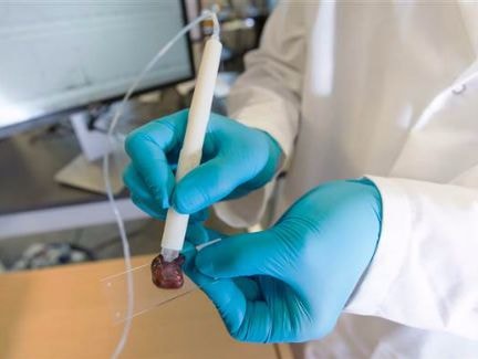 Chiếc bút phát hiện ung thư chỉ trong 10 giây