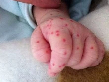 Cách phân biệt nhanh nhất sốt phát ban với sốt xuất huyết