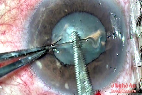 Video cận cảnh ca mổ giun chui vào mắt