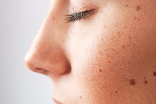 7 thực phẩm giảm nguy cơ ung thư da hiệu quả