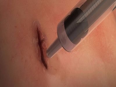 Keo y tế khiến vết thương hở lành sau 60 giây