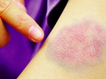 Dấu hiệu của bệnh ung thư bạch cầu