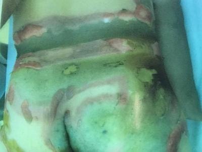 Bỏng nặng vùng mông và 'cậu nhỏ' vì để bật lửa trong túi quần