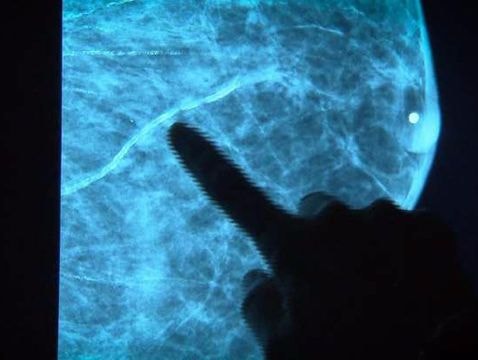 Phát hiện thêm 72 đột biết gen gây ra ung thư vú