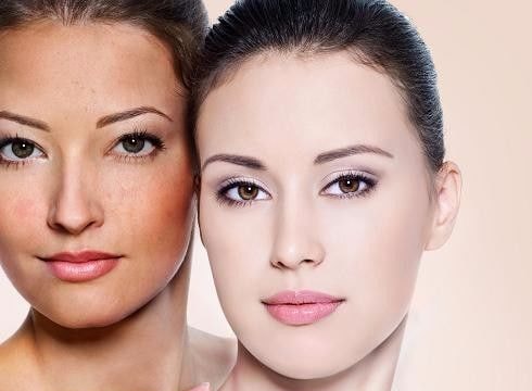 Các loại vitamin giúp chữa trị nám da hiệu quả