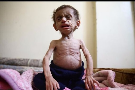 Những đứa trẻ chỉ còn da bọc xương ở Syria