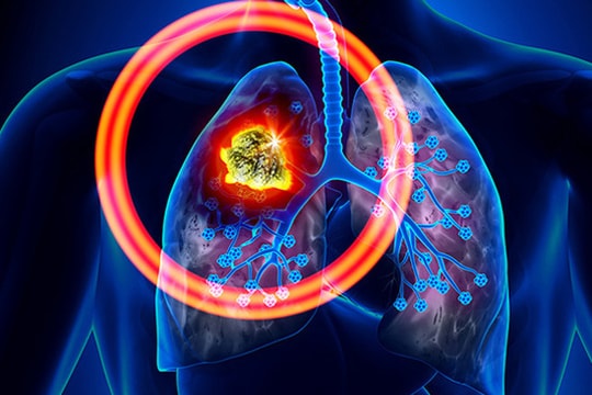 Thuốc lá làm tăng nguy cơ ung thư ở 10 bộ phận của cơ thể