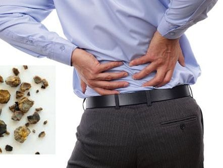 Những ai có nguy cơ mắc sỏi thận?