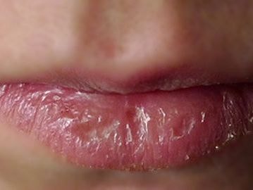 Mẹo giúp đôi môi nứt nẻ trở nên mịn màng