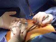 Cô gái chuyển giới chết sau khi nâng ngực tại phòng khám 'chui'