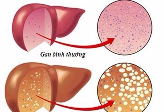 Dấu hiệu cảnh báo gan bị nhiễm độc