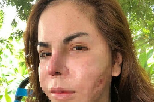 Silicon giả chất làm đầy: Chị em tiền mất, tật mang