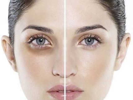 Mắt trũng 'tố cáo' điều gì?