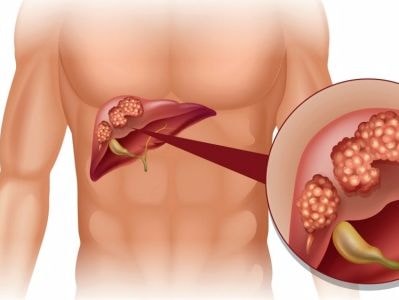 5 nguyên nhân gây ung thư gan bạn cần biết