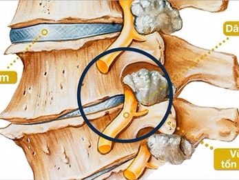 Nhận biết dấu hiệu thoái hóa cột sống
