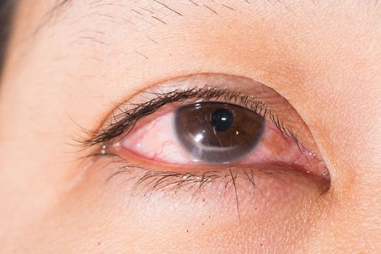 Biến chứng sau khi chữa bệnh mắt bằng phương pháp dân gian