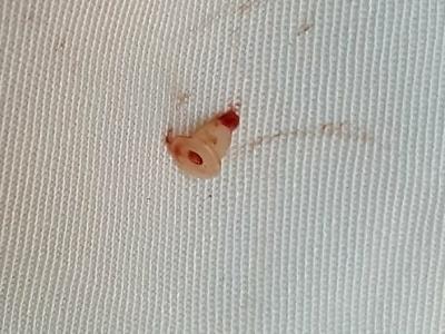 Ngỡ ngàng phát hiện nút nhựa trong vành tai bé gái 14 tuổi