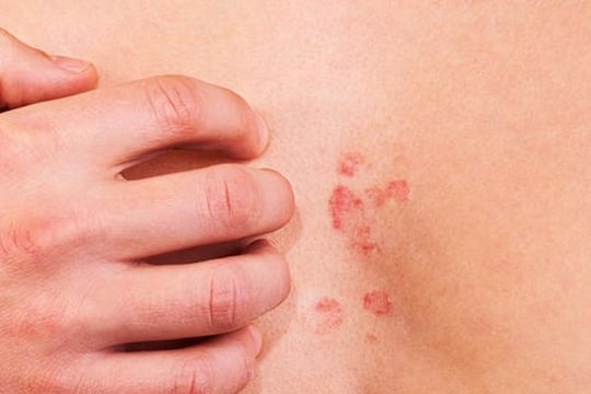 Những triệu chứng dị ứng thức ăn bạn không nên bỏ qua