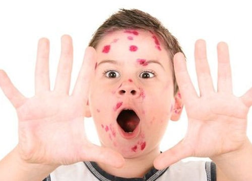 Bệnh thủy đậu rình rập khắp cả nước