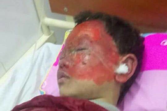 Cứu chữa đôi mắt cho nam sinh lớp 2 bị pháo nổ