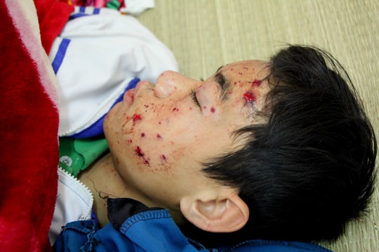 Nổ điện thoại khi đang sạc, nam sinh lớp 8 bị thương nặng