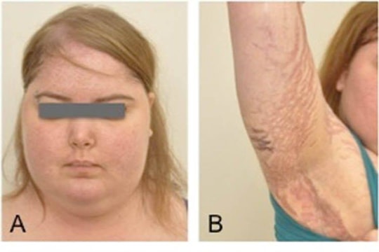 Bé gái 7 tuổi mọc râu, lông khắp người vì thuốc chữa biếng ăn