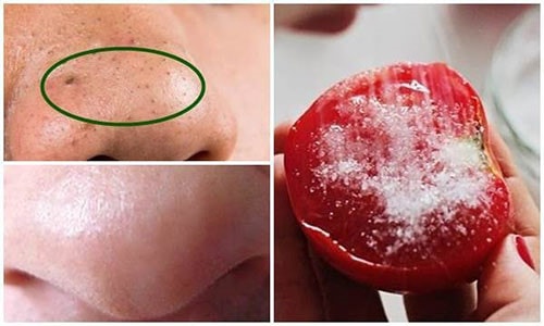 Lột sạch mụn đầu đen chỉ bằng 1 quả cà chua