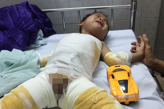 Xót thương hoàn cảnh bé trai bị bỏng nặng