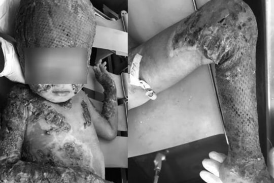 Người cha hiến da ghép cho con bị cháy toàn bộ cơ thể