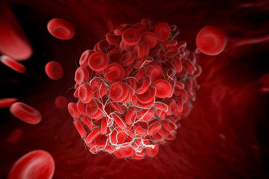 9 nguyên nhân và 6 dấu hiệu cảnh báo bạn có cục máu đông nguy hiểm