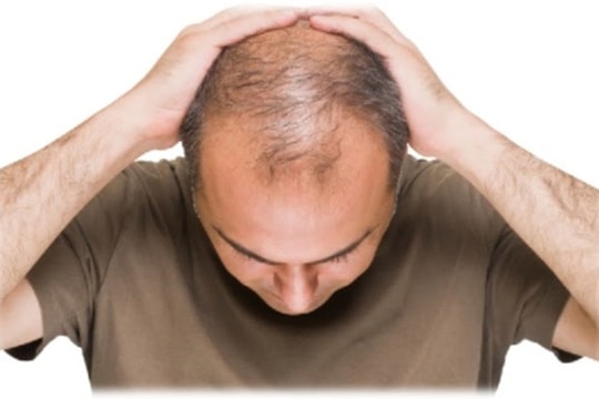 Chứng hói đầu có thể là dấu hiệu của bệnh tim