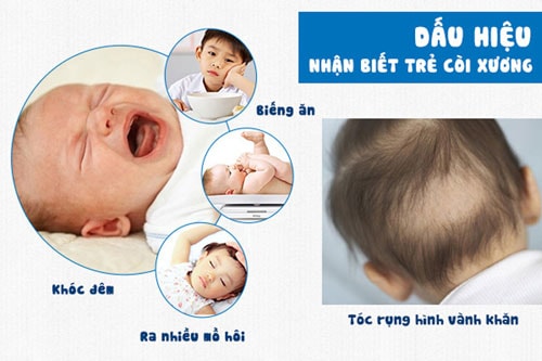 Điều bố mẹ cần biết về bệnh còi xương ở trẻ 