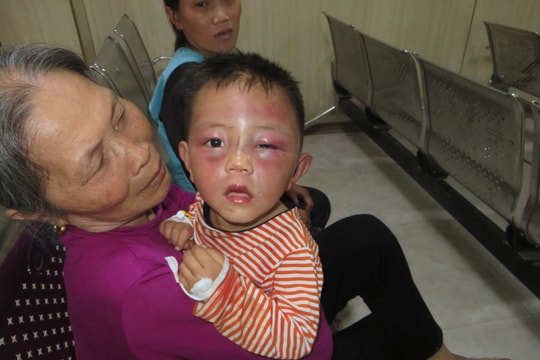 Vụ bé trai 2 tuổi bị bạo hành ở Nghệ An: Triệu tập bố dượng