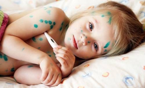 Cảnh báo biến chứng khi tùy tiện dùng Đông y trị thủy đậu