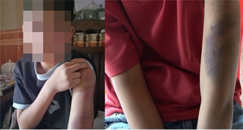 Bé trai bị bố và mẹ kế đánh bầm tím khắp người