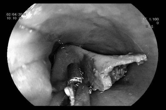 Mảnh xương đùi gà lớn hóc ở cổ bé gái