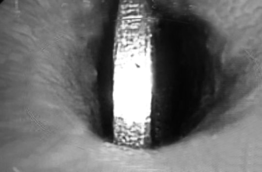 Đồng xu kẹt cứng trong thực quản bé gái 5 tuổi