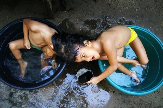 Hình ảnh thương cảm của hai cô gái dính liền đầu