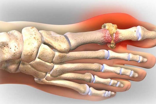Những đồ ăn giúp bạn giảm cơn đau gout