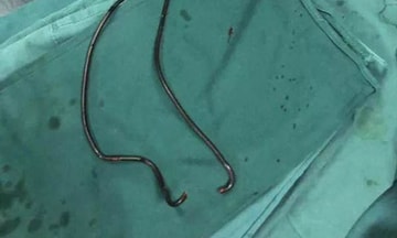 Cụ ông U70 nhét dây cáp điện thoại dài gần 1m vào 'của quý'