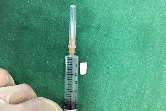 Nghệ An: Bé gái 12 tháng hóc cùi dừa, nguy kịch tính mạng