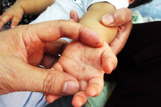 Nghệ An: Bệnh ho gà và tay chân miệng gia tăng